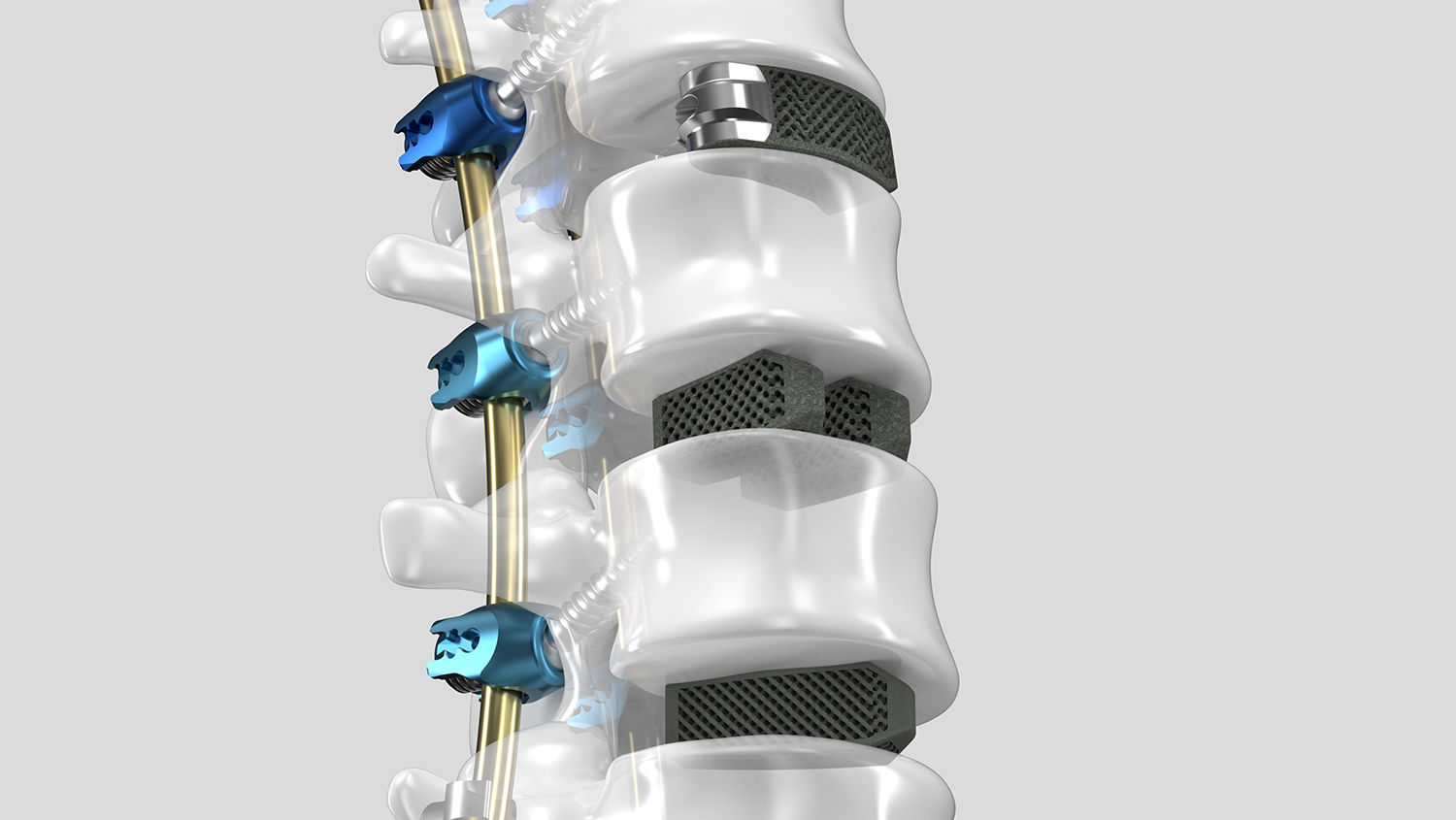 Ennovate® Thoracolumbar & Sacropelvic s 3D meziobratlovými fúzními klecemi AESCULAP®