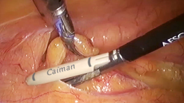 EinsteinVision® v laparoskopické chirurgii s efektem automatického zaostření