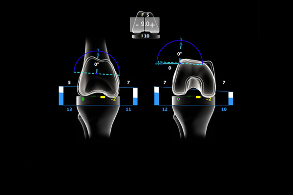 Femur Planning